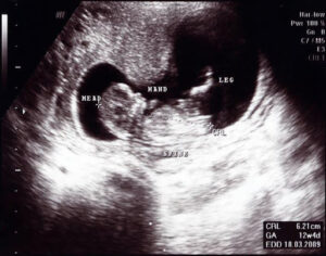 Week 12: You Made It—End of the First Trimester