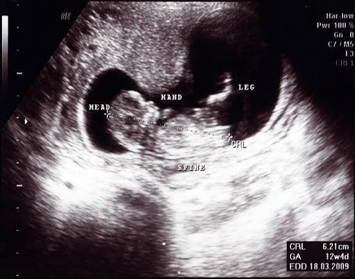Week 12: You Made It—End of the First Trimester