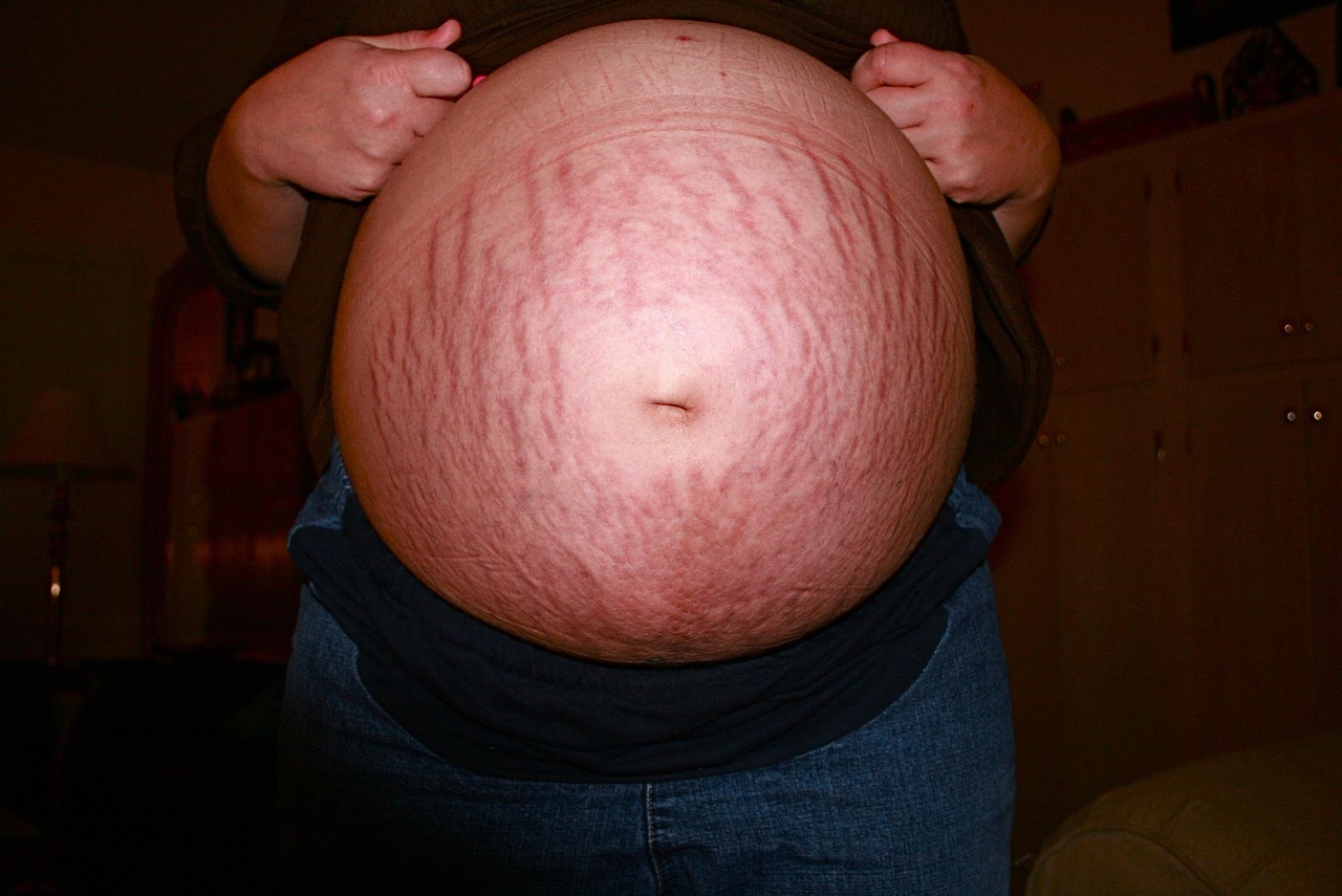 Stretch Marks in Pregnancy: Can They Be Prevented and Do They Fade?
